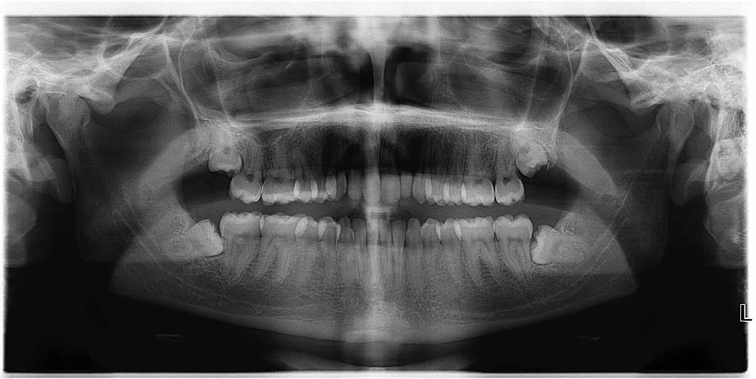 Comment savoir si je dois faire extraire mes dents de sagesse?