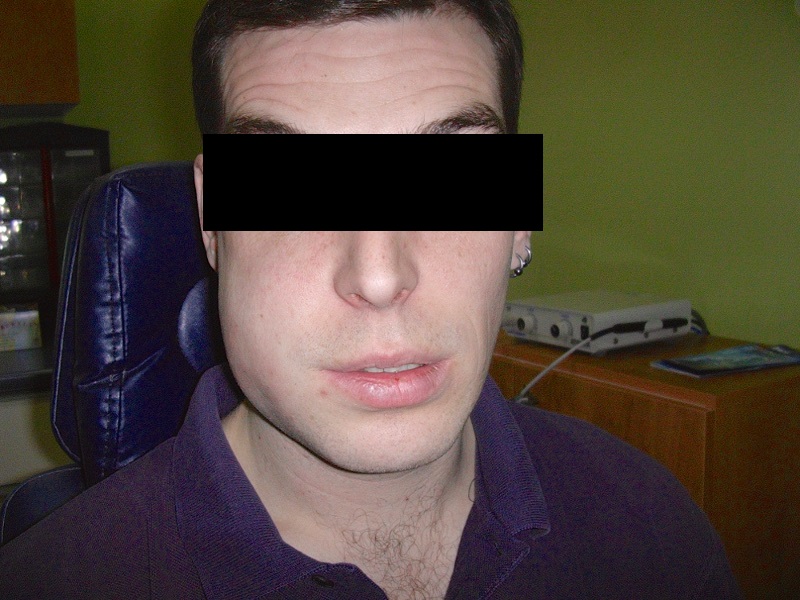 Quelles sont les douleurs qui surviennent si je ne fais pas extraire mes dents de sagesse?