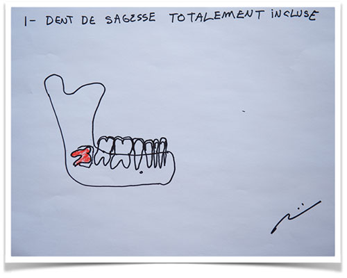 Quel est le risque de ne pas faire extraire les dents de sagesse?