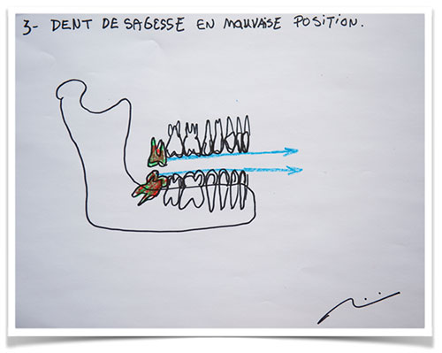 Dent de sagesse mauvaise position Sherbrooke